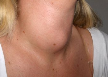 Tiroide Hashimoto: cos'è, cause e sintomi