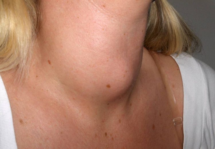 Tiroide Hashimoto: cos'è, cause e sintomi