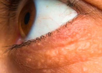 Colesterolo alto: i sintomi campanello d'allarme