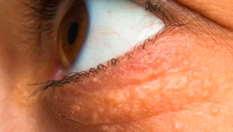 Colesterolo alto: i sintomi campanello d'allarme