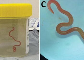 Aveva febbre e depressione: era un verme vivo nel cervello