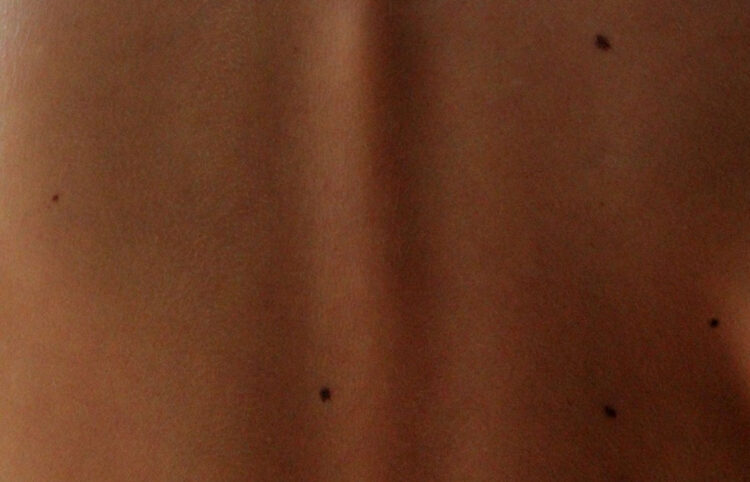 Il melanoma in Sicilia: il terzo tumore più frequente sotto i 50 anni