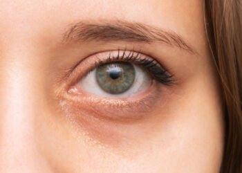 Occhiaie: rimedi in casa