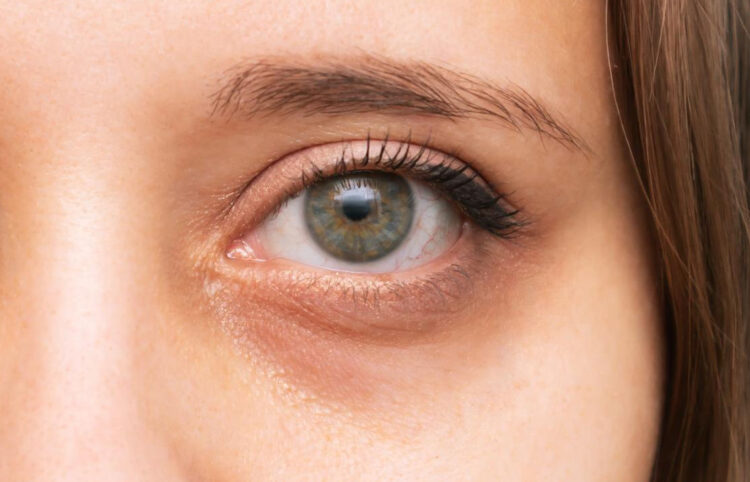 Occhiaie: rimedi in casa