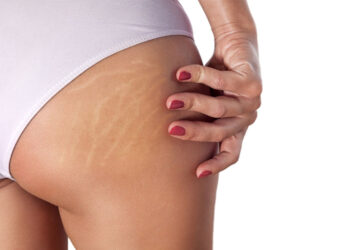 Smagliature: cosa sono e come eliminarle