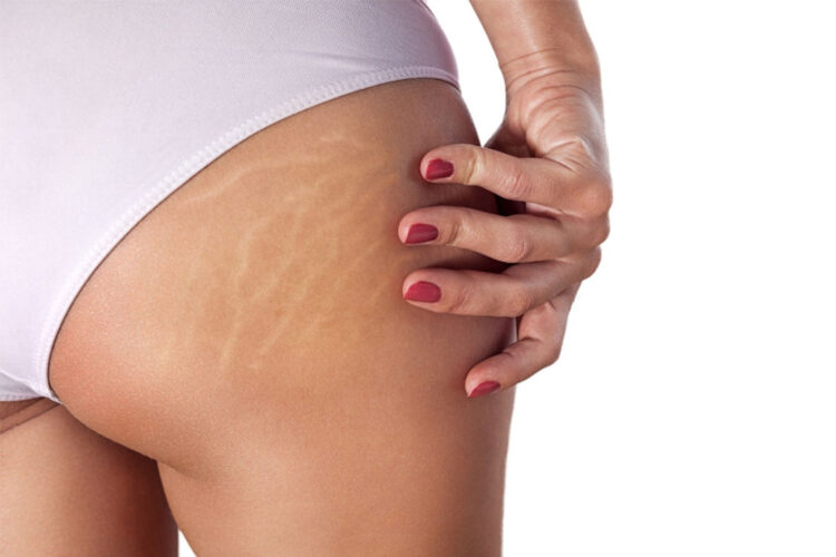 Smagliature: cosa sono e come eliminarle