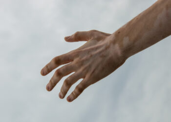 trattamento vitiligine con ruxolitinb