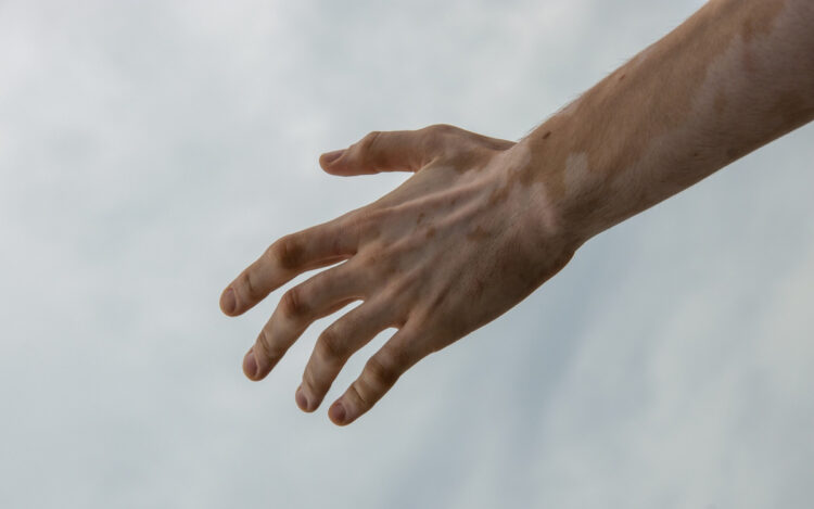 trattamento vitiligine con ruxolitinb