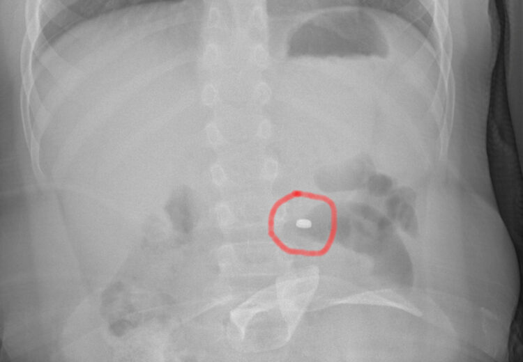 Bimbo ingoia pila a bottone, estratta in sala operatoria