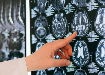 Neuralink: malfunzionamento del primo chip impiantato su umano