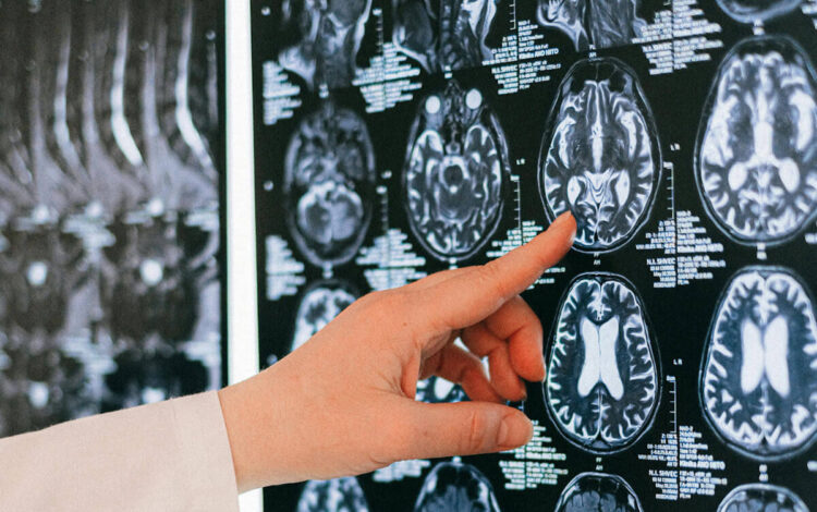 Neuralink: malfunzionamento del primo chip impiantato su umano