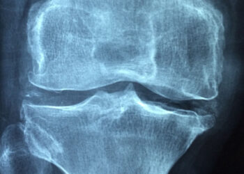 Una pepita d'oro contro l'osteoporosi: ecco cosa fa alle ossa