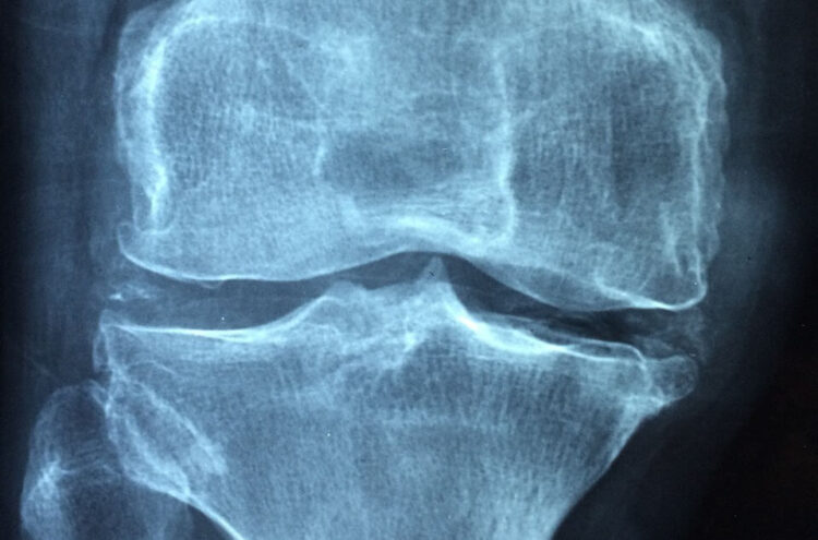 Una pepita d'oro contro l'osteoporosi: ecco cosa fa alle ossa