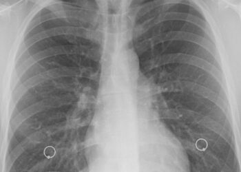 Carcinoma polmonare: ogni anni 34 mila morti