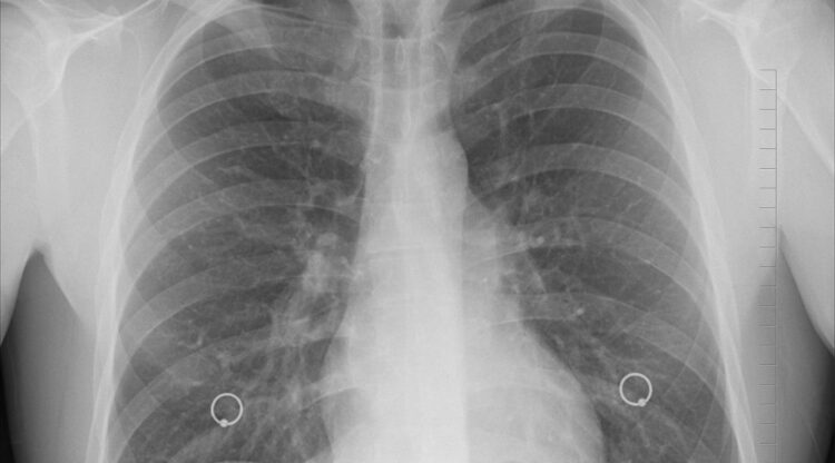 Carcinoma polmonare: ogni anni 34 mila morti