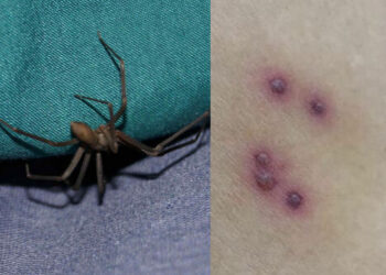 Come riconoscere il morso di un ragno violino e cosa fare