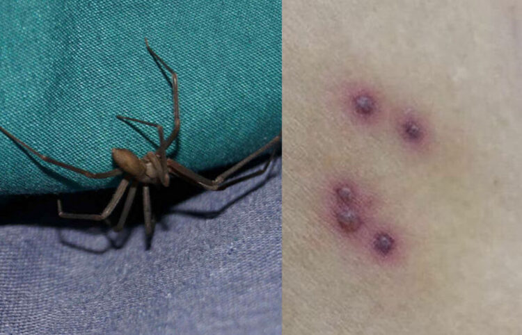Come riconoscere il morso di un ragno violino e cosa fare