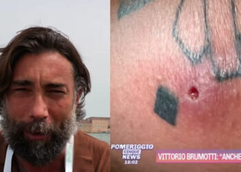 Vittorio Brumotti morso da ragno violino: ho avuto la febbre a 41