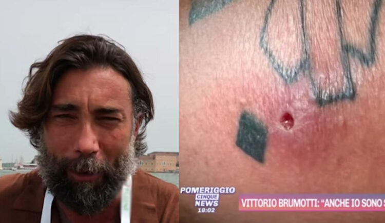 Vittorio Brumotti morso da ragno violino: ho avuto la febbre a 41