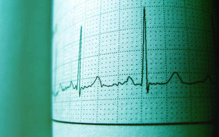 elettrocardiogramma