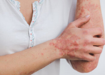 Psoriasi, screening gratuito a Scicli: ecco come prenotare