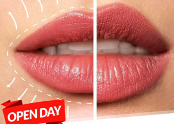 Labbra perfette rimpolpate naturalmente: open day a Ragusa