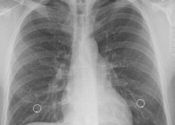 Tumore del polmone: aumento sopravvivenza nei pazienti con mutazione EGFR