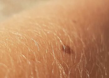 LILT Ragusa, campagna di prevenzione dei tumori cutanei: come prenotare la visita