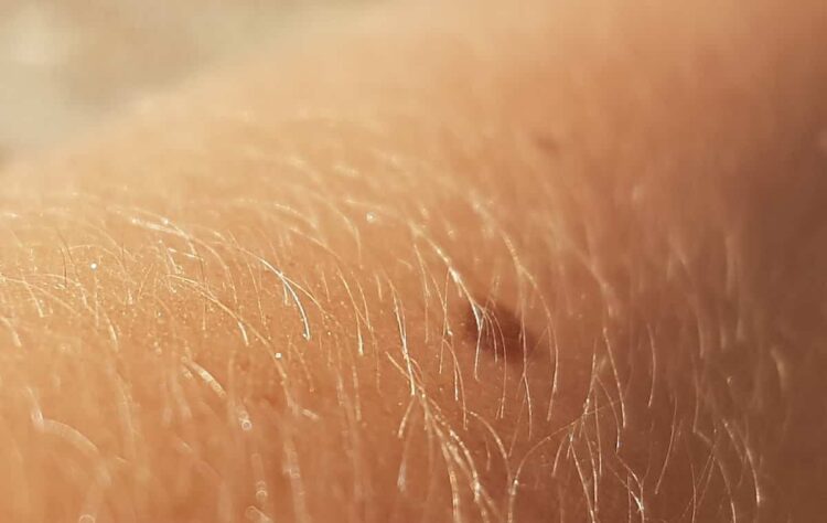 LILT Ragusa, campagna di prevenzione dei tumori cutanei: come prenotare la visita