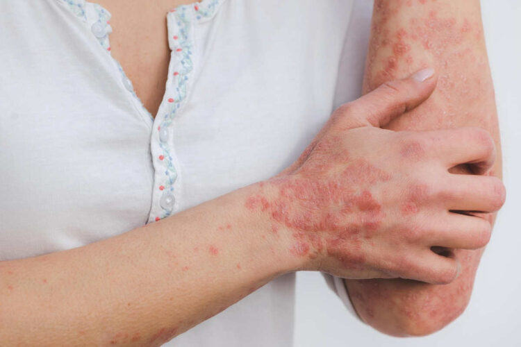 A Scicli la campagna "Psoriasi? Affrontiamola insieme": visite gratuite su prenotazione