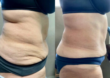 Cellulite: i falsi miti, i rimedi reali e la strategia definitiva per combatterla