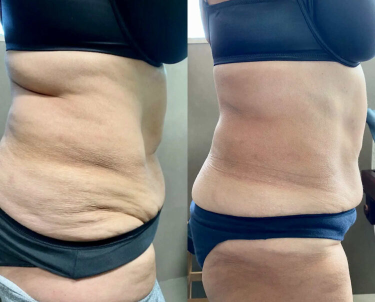 Cellulite: i falsi miti, i rimedi reali e la strategia definitiva per combatterla