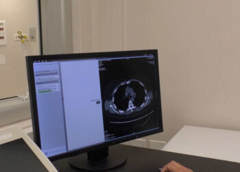 Tumore al polmone, diagnosticati tumori e inviati pazienti ai centri antifumo