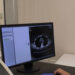 Tumore al polmone, diagnosticati tumori e inviati pazienti ai centri antifumo