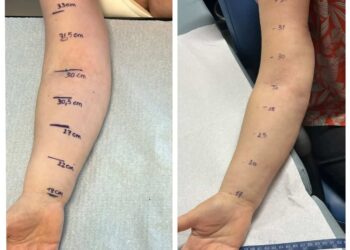 Linfedema dopo intervento per tumore al seno: al Cannizzaro di Catania primo Linfo-DIEP