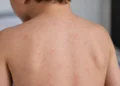 Schiena di un bambino ripreso di spalle, con piccole macchie rosse diffuse sulla pelle simili a quelle dei casi di morbillo
