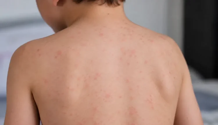 Schiena di un bambino ripreso di spalle, con piccole macchie rosse diffuse sulla pelle simili a quelle dei casi di morbillo