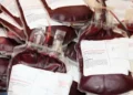 Sacche di sangue raccolte durante le donazioni, pronte per la trasfusione